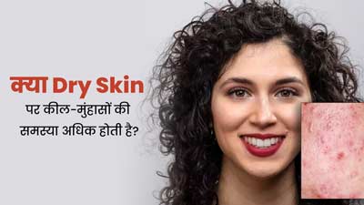 Dry Skin: क्या ड्राई स्किन पर कील-मुंहासे अधिक होते हैं? जानें एक्सपर्ट की राय