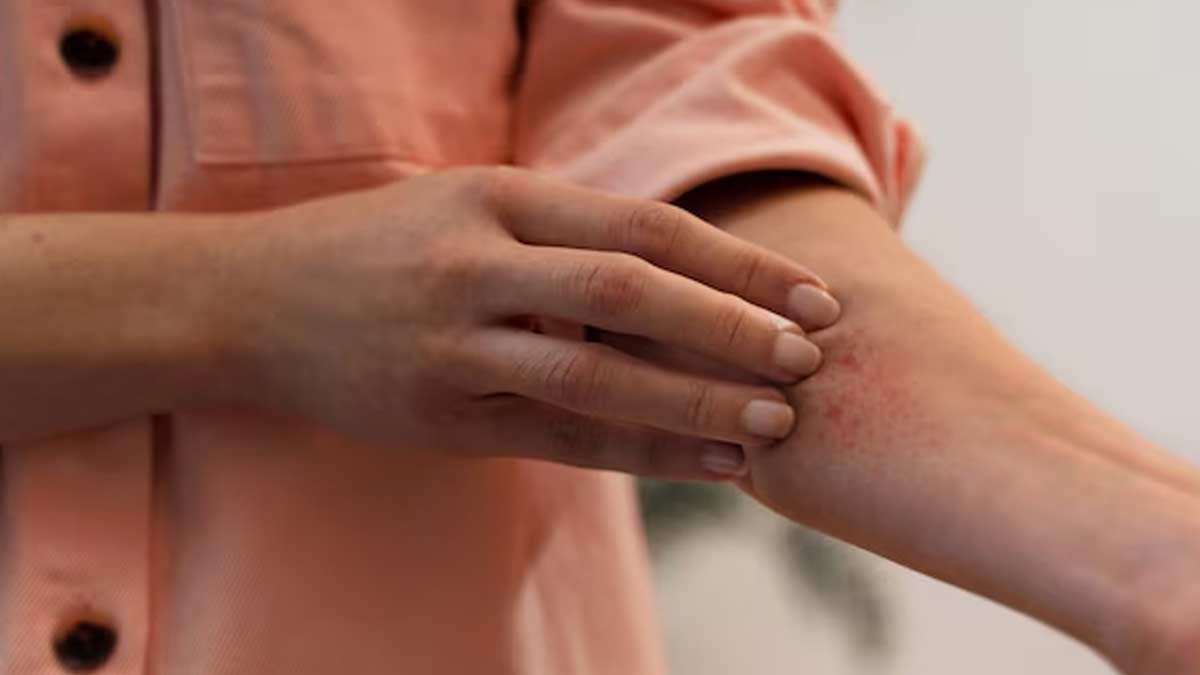 Summer-skin-infection-ins