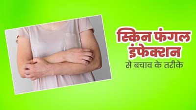 गर्मियों में बढ़ जाता है त्वचा पर फंगल इंफेक्शन का खतरा, एक्सपर्ट से जानें इससे बचाव के तरीके