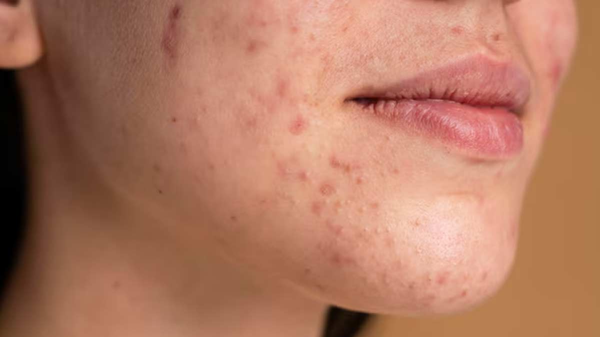 hormonal acne