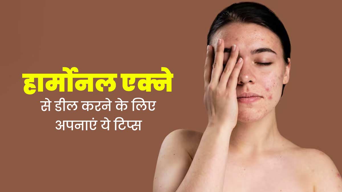 हार्मोनल एक्ने से डील करने के लिए अपनाएं ये 6 टिप्स, दूर होगी समस्या