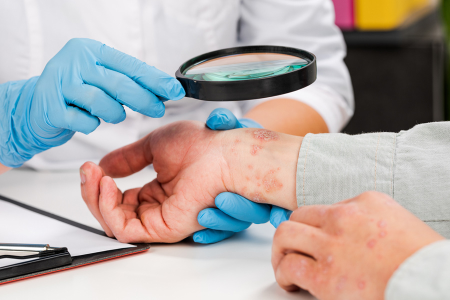 eczema