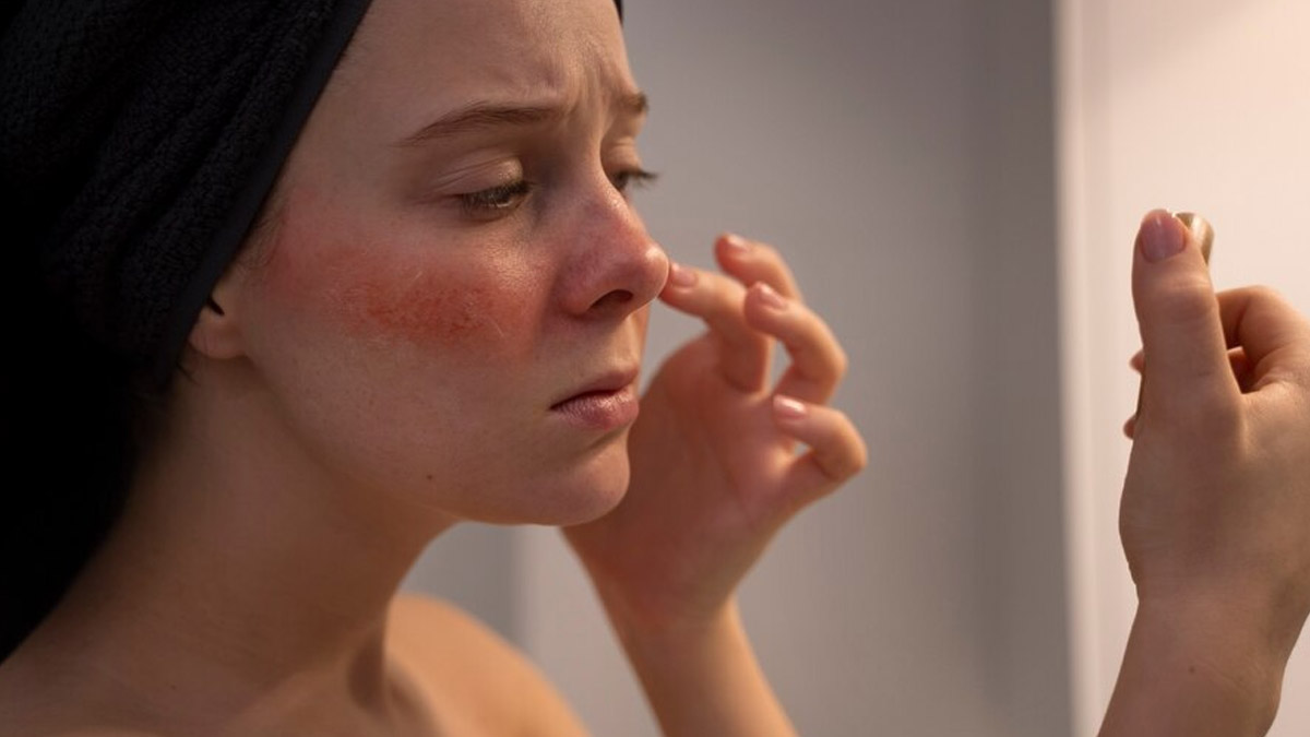 Dealing With Chronic Skin Conditions? Expert Explains Ways To Manage Conditions Like Rosacea