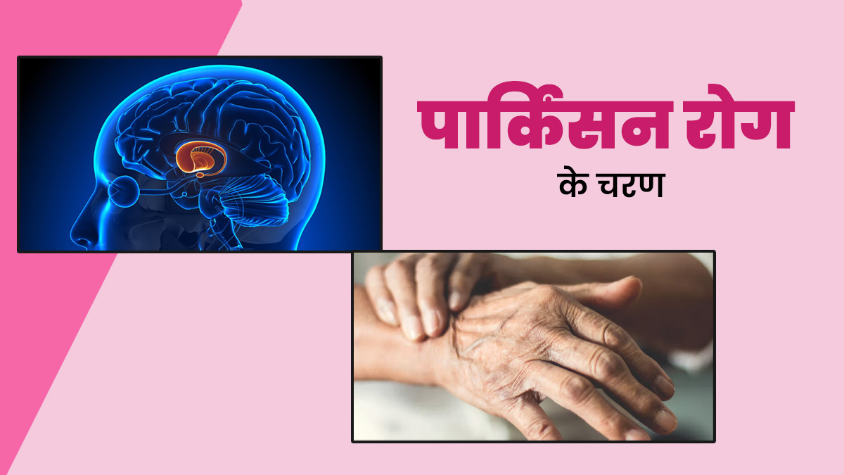 Parkinson's Disease Stages: पार्किंसन रोग के होते हैं ये 5 चरण, जानें इसके लक्षण