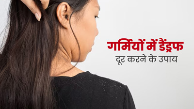 गर्मियों में डैंड्रफ से छुटकारा पाने के लिए अपनाएं ये 3 घरेलू उपाय, मिलेगा फायदा