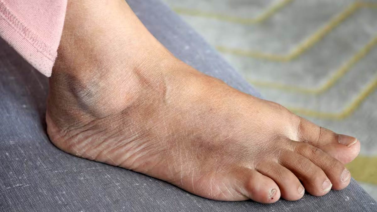 Dealing With Swollen Feet? Try These Natural Remedies For Relief |  OnlyMyHealth