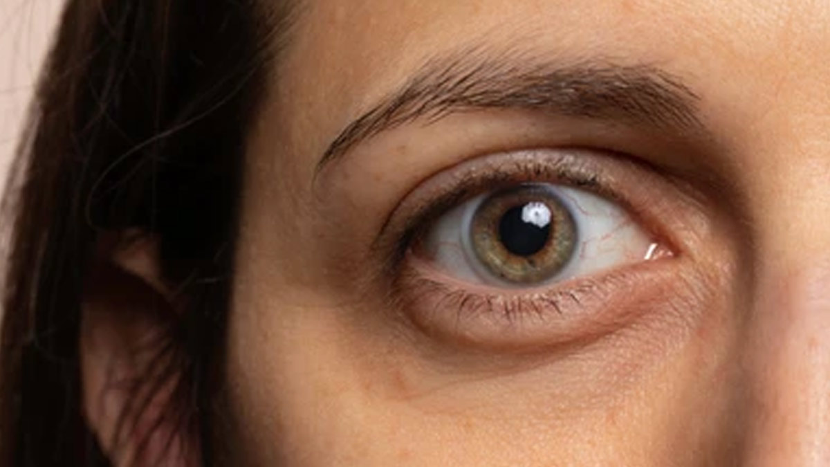 Bulging Eyes, Feeling Irritation In The Eye? It Could Be Thyroid Eye Disease