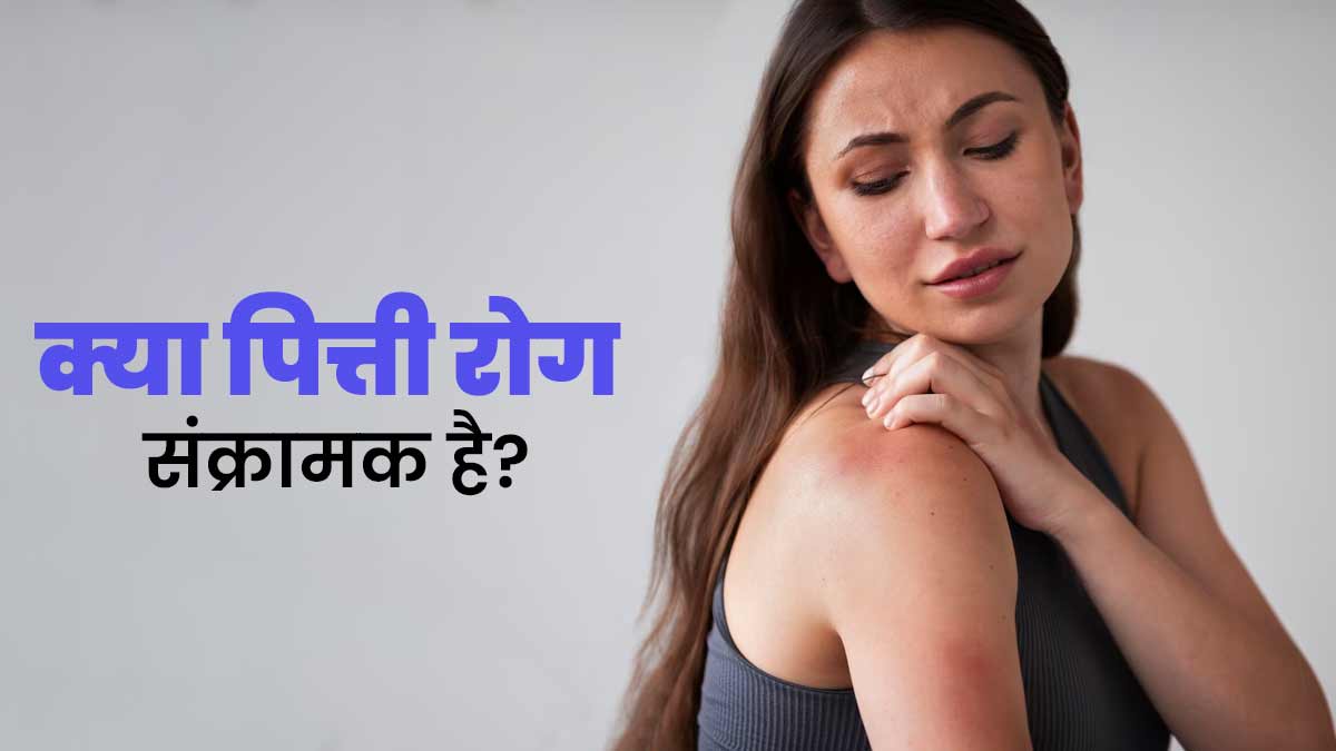 क्या पित्ती रोग एक व्यक्ति से दूसरे में फैल सकता है? जानें डॉक्टर की राय