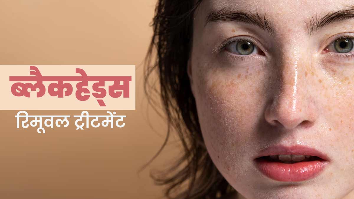 ब्लैकहेड्स हटाने में मदद करेगा दालचीनी और टी ट्री ऑयल का पेस्ट, जानें इस्‍तेमाल का तरीका