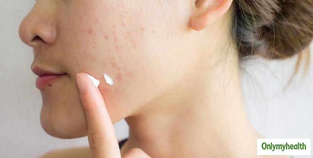 Benefits of Salicylic Acid in Your Skincare Routine