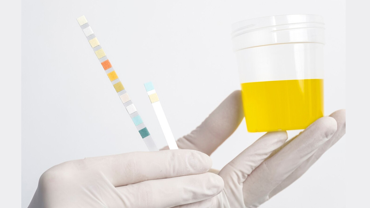 Expert Answers Why Urine Test Is A Part Of Diabetes Check Up ...