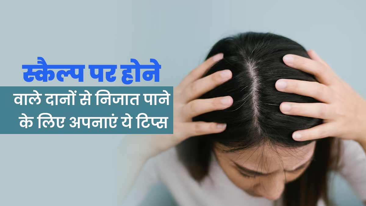 गर्मियों में स्कैल्प पर होने वाले दानों से निजात पाने के लिए अपनाएं ये टिप्स, मिलेगा फायदा