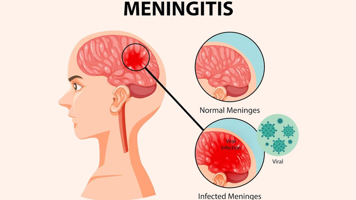Meningitis