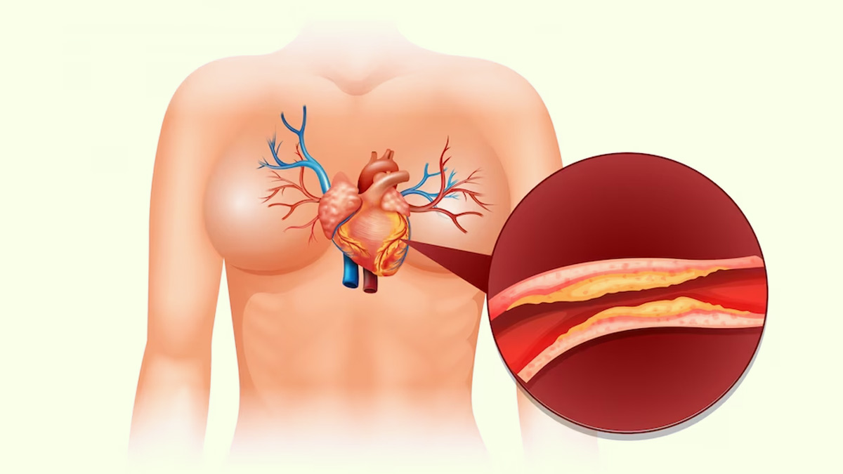 Plague In Your Arteries: What Are The Best Nutrient To Remove It