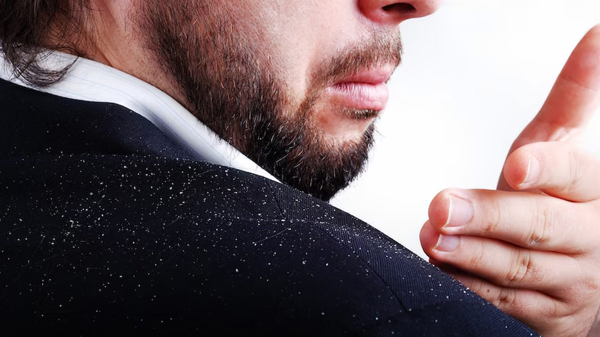 home remedies for dandruff