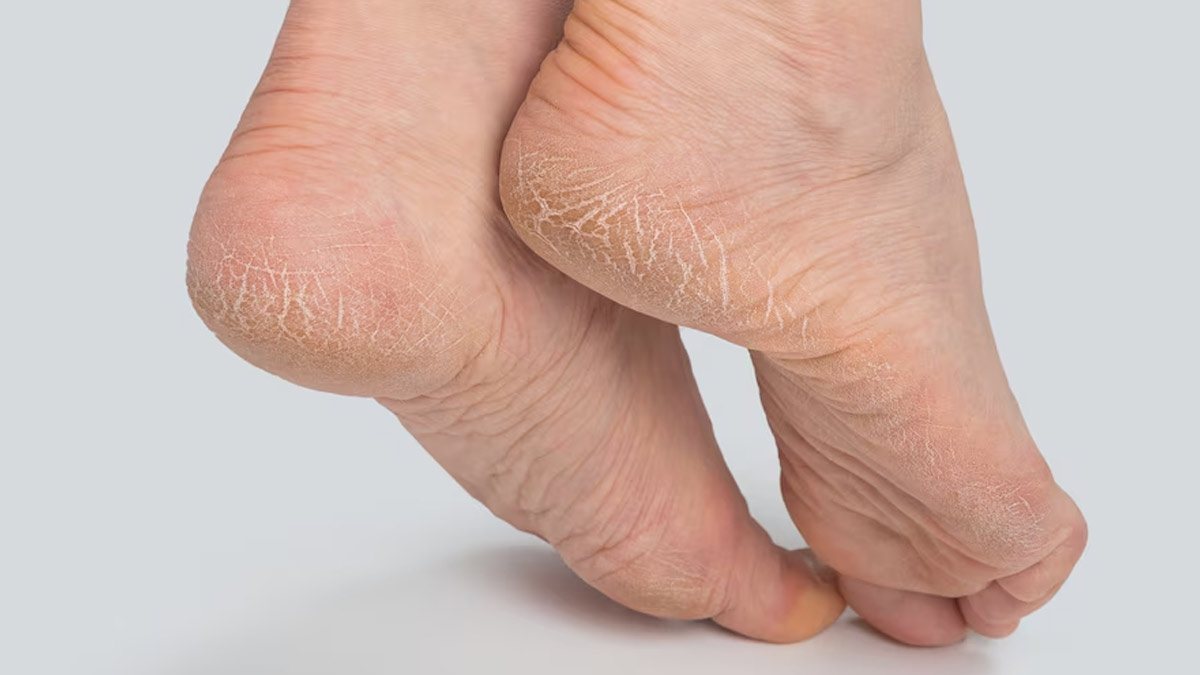 Troubled With Cracked Heels? Here's Why You Should Use Camphor To Treat Your Heels