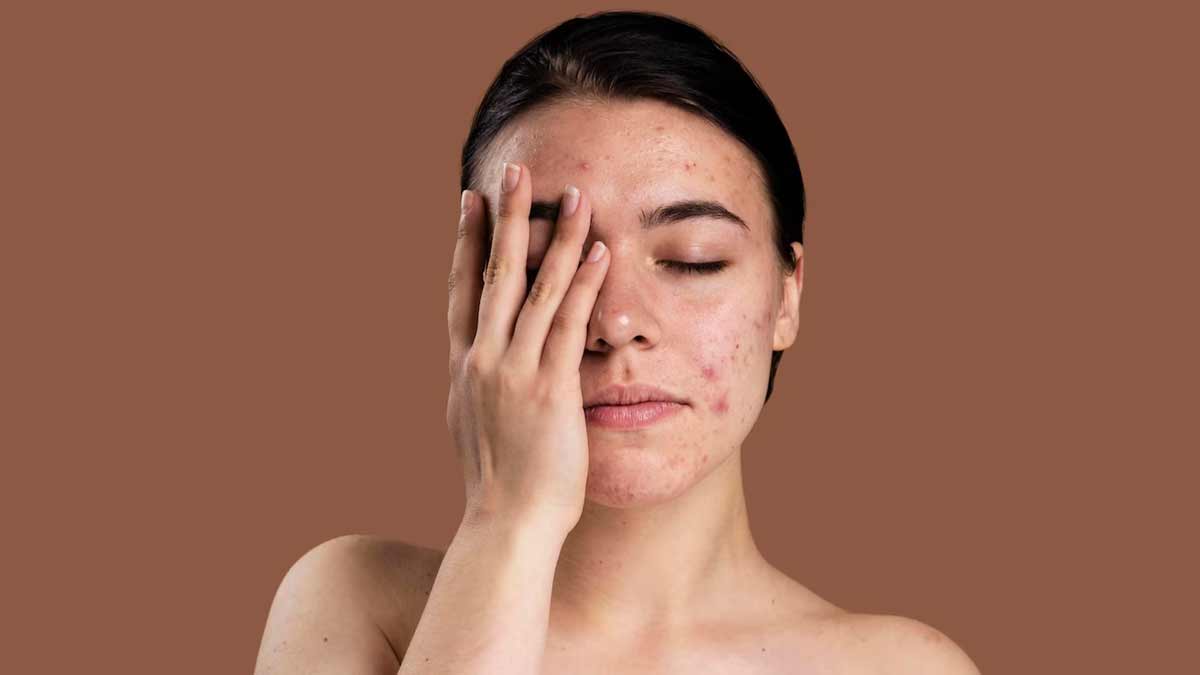 pimple mark removal remedy