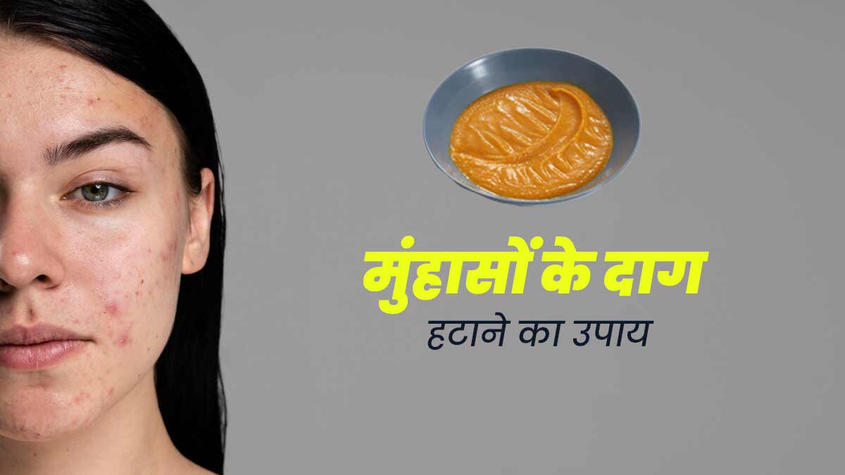 मुंहासों के दाग हटाने के लिए लगाएं बेसन और ऑरेंज पील पाउडर से बना पेस्‍ट, मिलेगी निखरी-बेदाग त्वचा