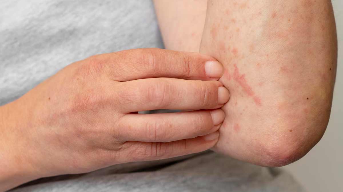 skin infection at gym