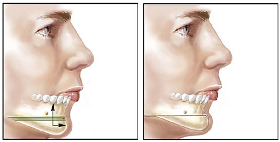 Chin Implant