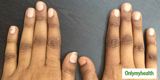 Causes and Prevention Tips for Dark Knuckles