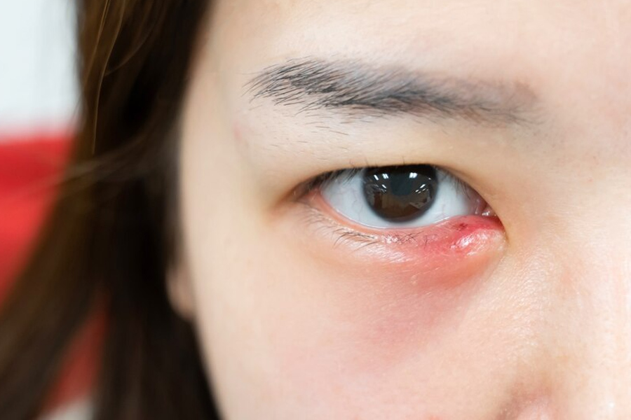 eye