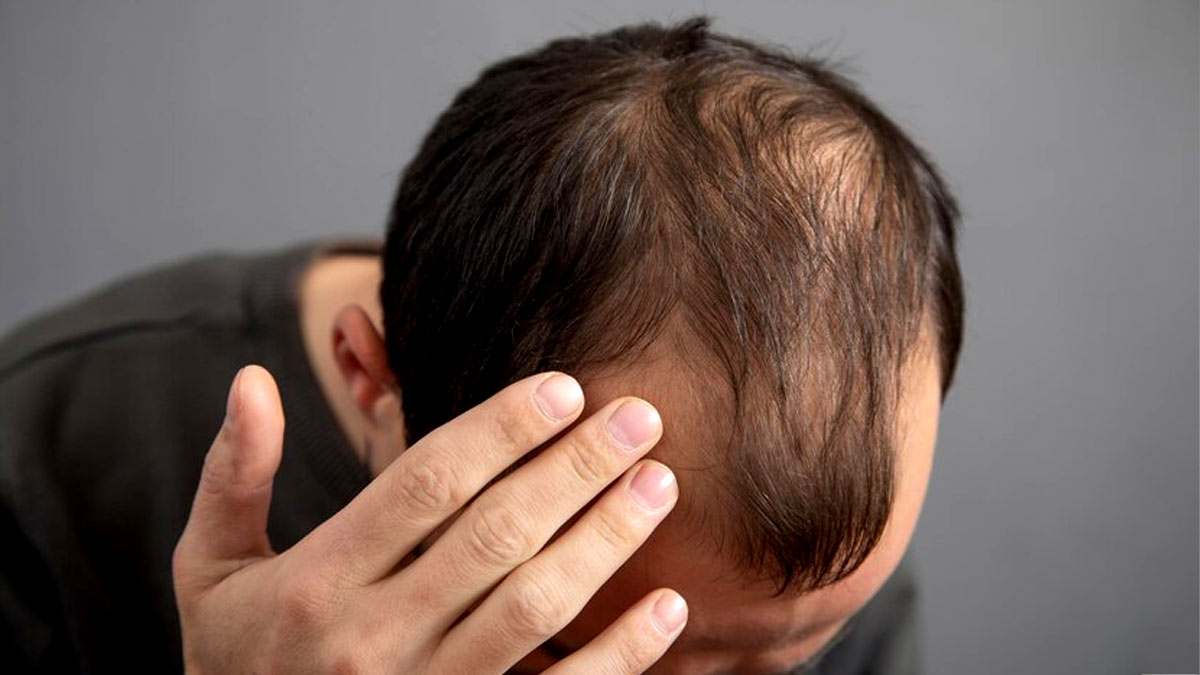 Alopecia Areata: What Are The Important Minerals To Treat It