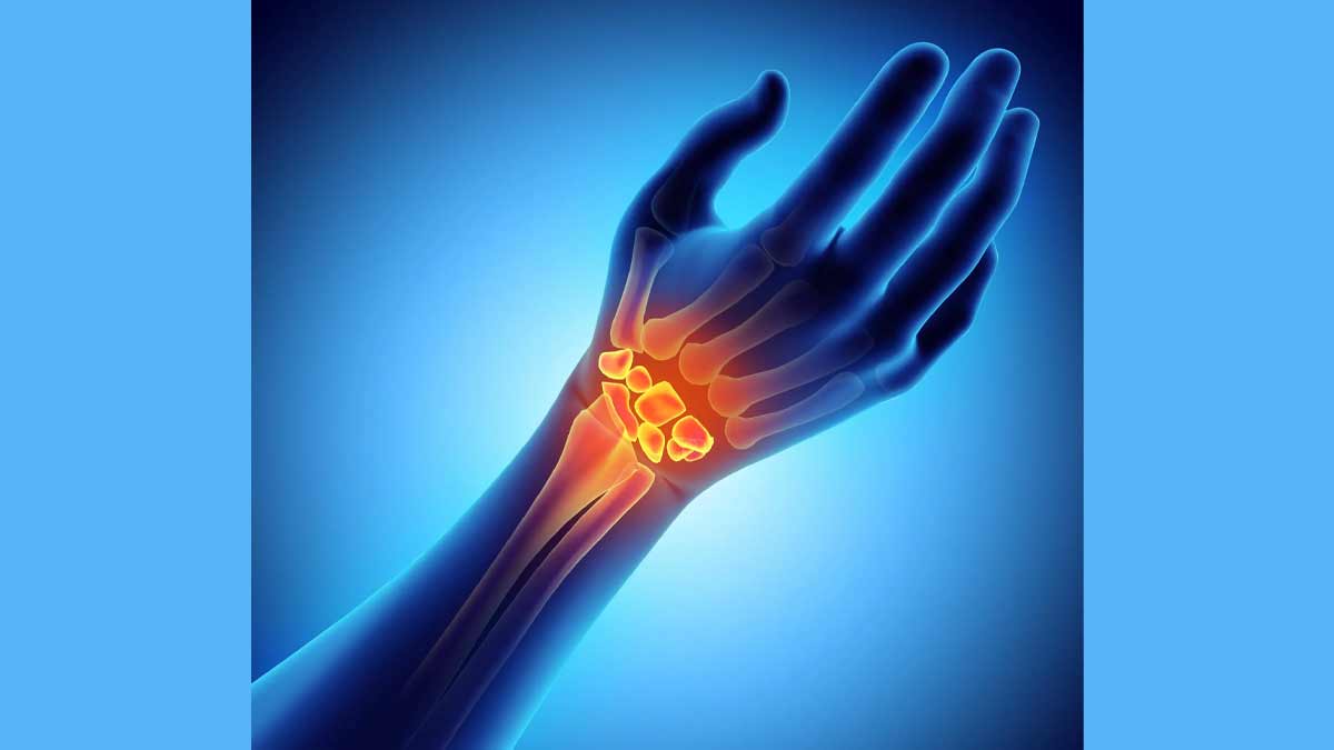 carpal tunnerl syndrome