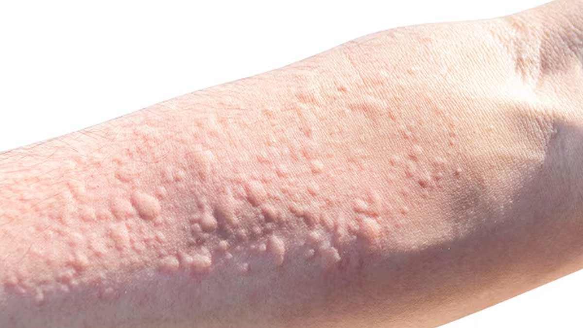 hives