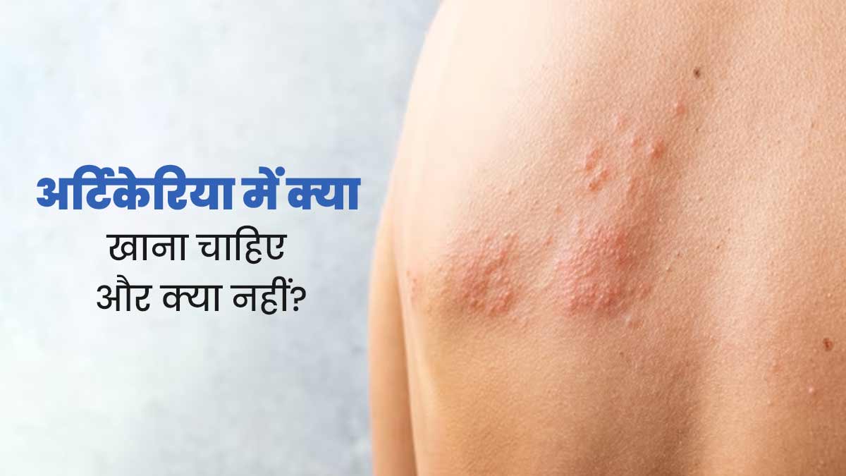 अर्टिकेरिया (त्वचा में पित्ती उछलने) होने पर क्या खाना चाहिए और क्या नहीं? जानें डॉक्टर से 