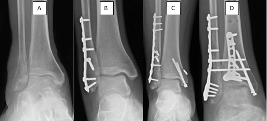 Ankle Fracture