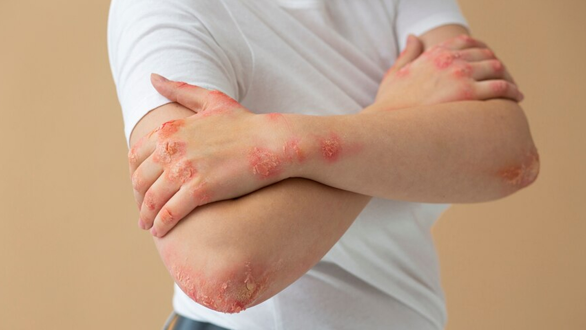 diabetes increase risk of fungal infection