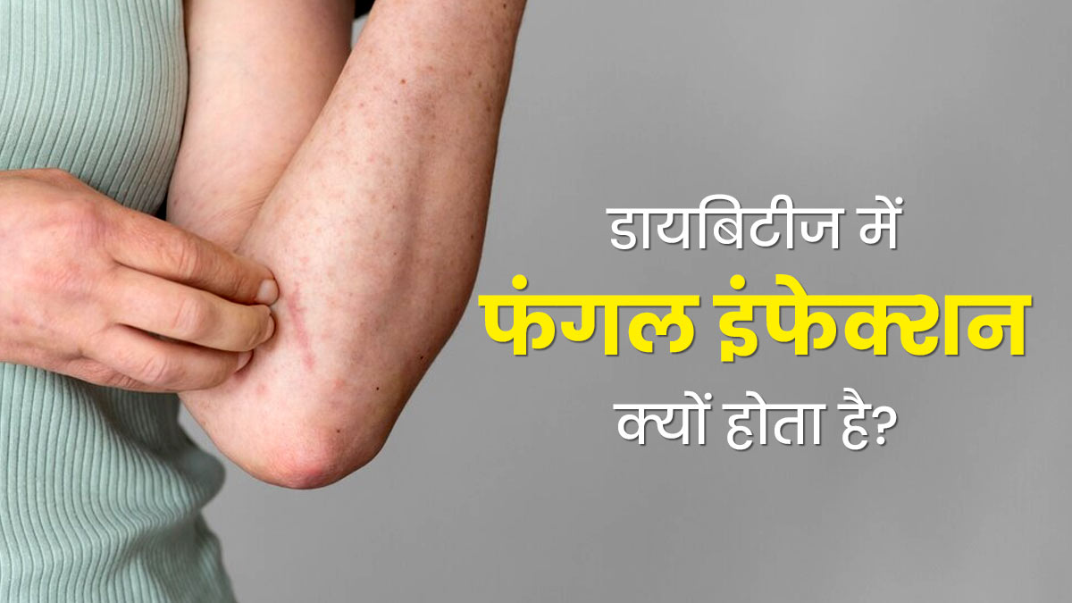 डायबिटीज में फंगल इंफेक्शन का जोखिम अधिक क्यों होता है? डॉक्टर से जानें