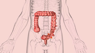 Diverticulitis: Symptoms, Causes, Prevention And Treatment To Know