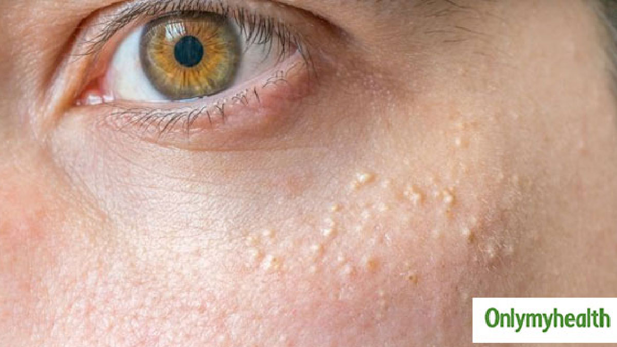 causes and symptoms of milia under eyes 