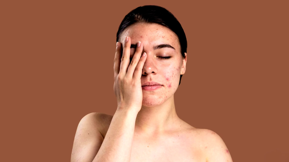 Makeup Dos And Donts to Avoid Acne