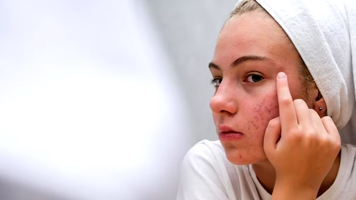 Makeup Dos And Donts to Avoid Acne