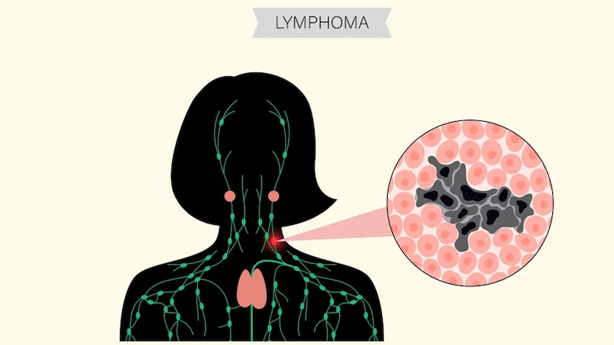 Do You Know About The Different Types Of Leukemia? Expert Explains ...