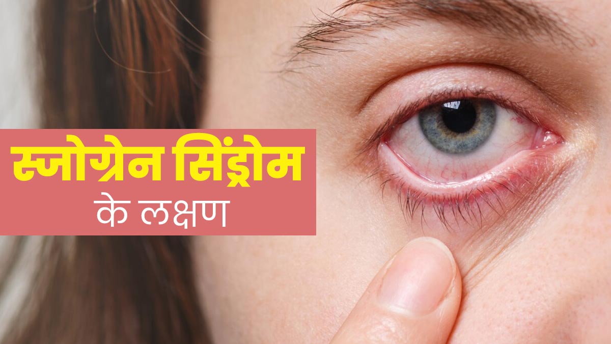 आंख और मुंह में ड्राईनेस की समस्या स्जोग्रेन सिंड्रोम का हो सकता है कारण, जानिए इसके लक्षण