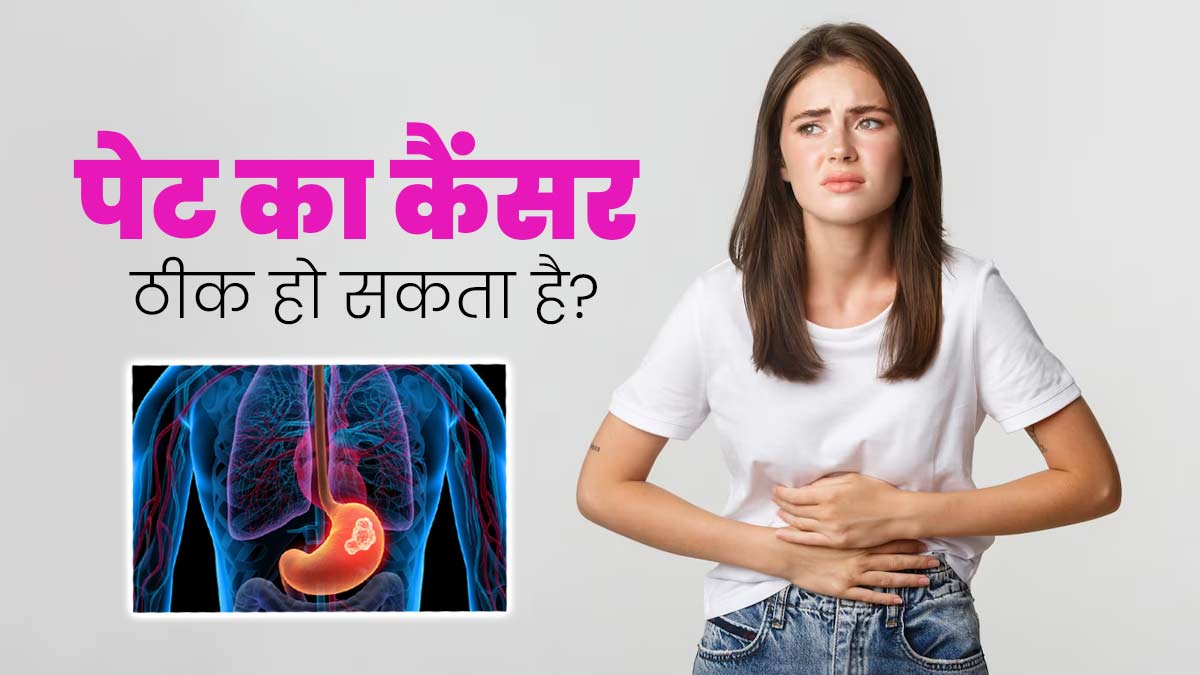 Stomach Cancer: क्या पेट का कैंसर पूरी तरह से ठीक हो सकता है? डॉक्टर से जानें
