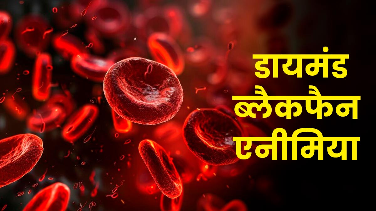 डायमंड ब्लैकफैन एनीमिया क्‍या होता है? जानें इसके लक्षण, कारण और इलाज 