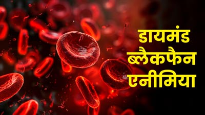डायमंड ब्लैकफैन एनीमिया क्‍या होता है? जानें इसके लक्षण, कारण और इलाज 