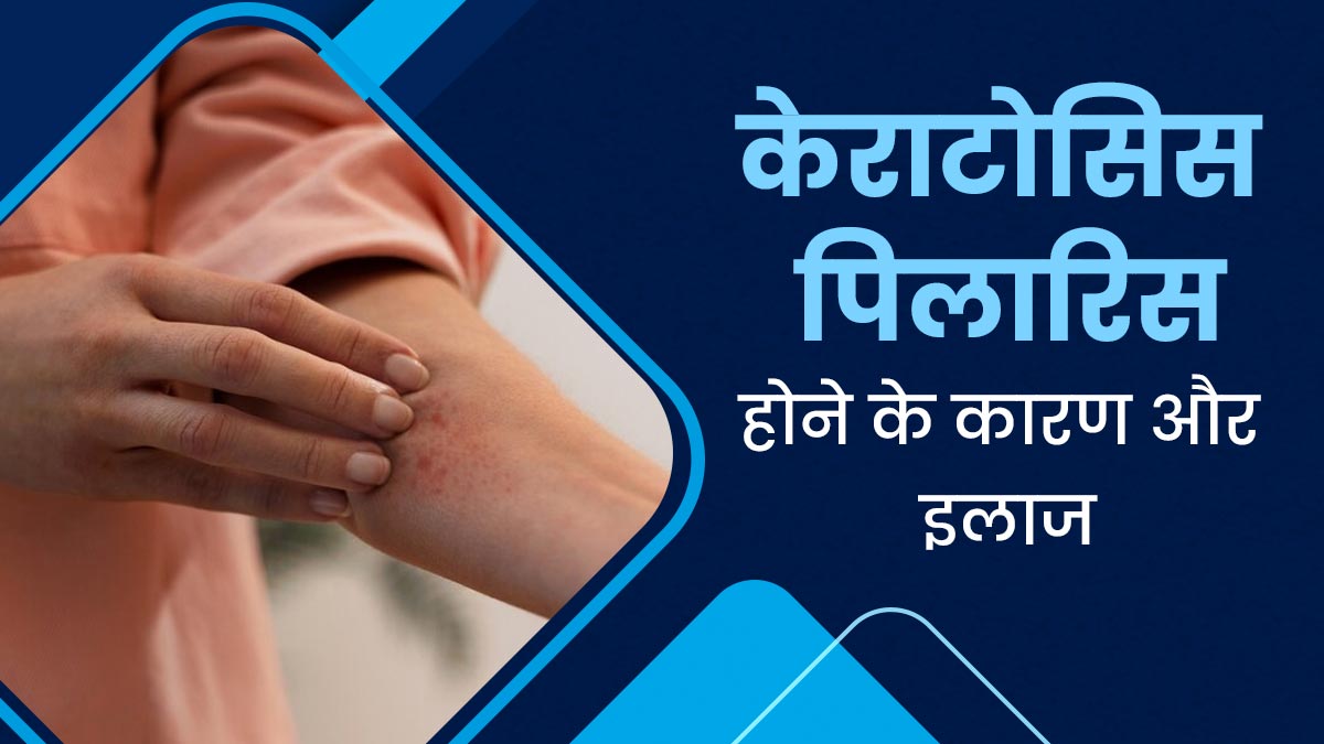 केराटोसिस पिलारिस (त्वचा पर पैच) क्या होता है? जानें इसके कारण और इलाज