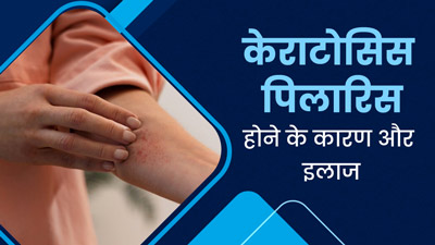केराटोसिस पिलारिस (त्वचा पर पैच) क्या होता है? जानें इसके कारण और इलाज