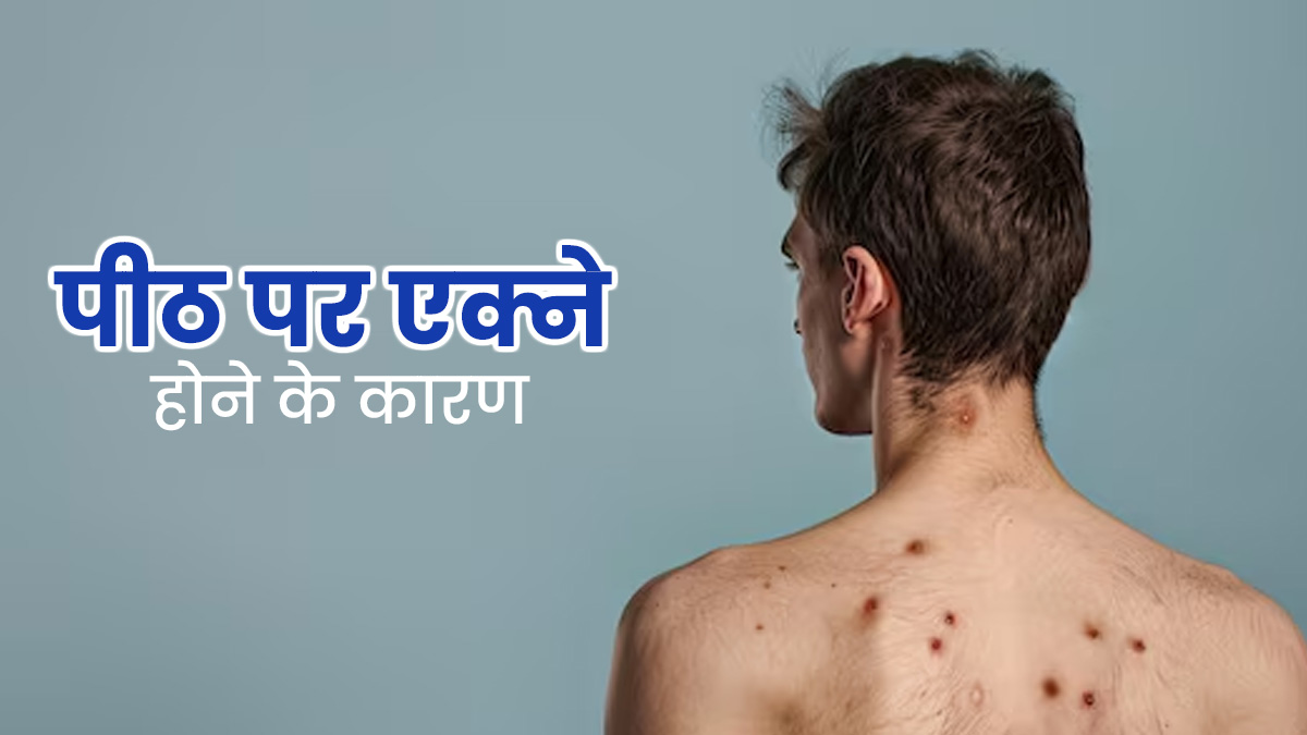 पीठ पर एक्ने क्यों होते हैं? एक्सपर्ट से जानें कारण और बचाव के तरीके 
