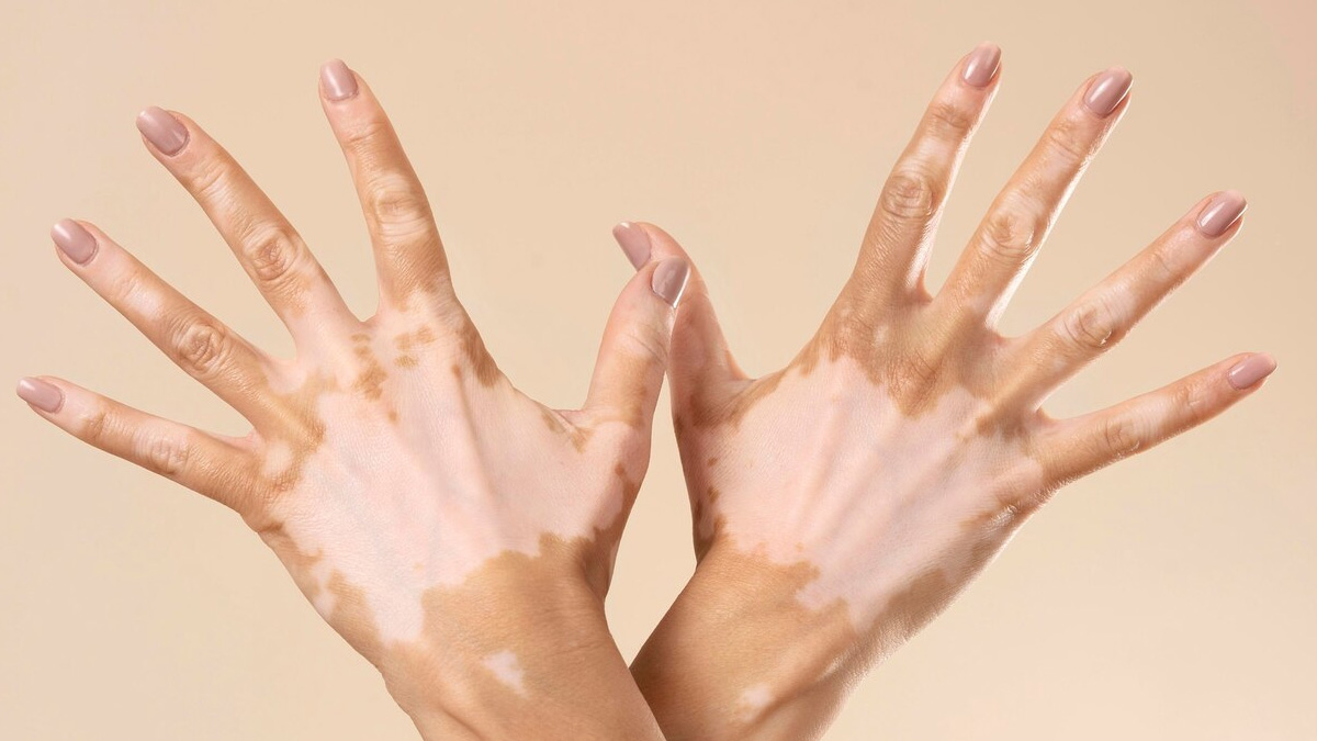 vitiligo