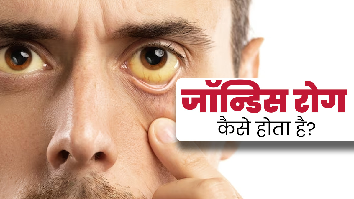 पीलिया रोग क्या है? डॉक्टर से जानें इस बीमारी के बारे में विस्तार से