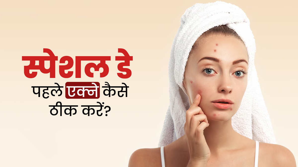 किसी स्पेशल डे से पहले चेहरे पर निकल आते हैं पिंपल्स, तो इन टिप्स से पाएं छुटकारा 