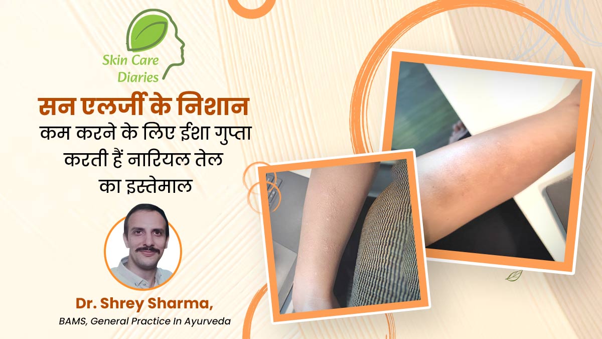 धूप की वजह से ईशा के हाथों पर हो गई थी एलर्जी, इसके निशान मिटाने के लिए नारियल तेल का किया इस्तेमाल