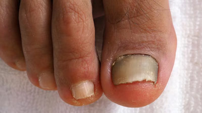 Home Remedies: How To Treat The Toenail Fungus At Home